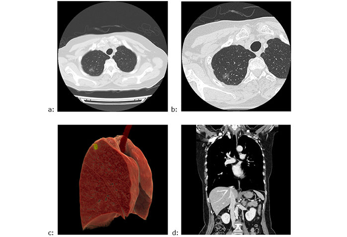 CANON MEDICAL AND NCC START CLINICAL RESEARCH OF NEXT-GENERATION CT SYSTEM